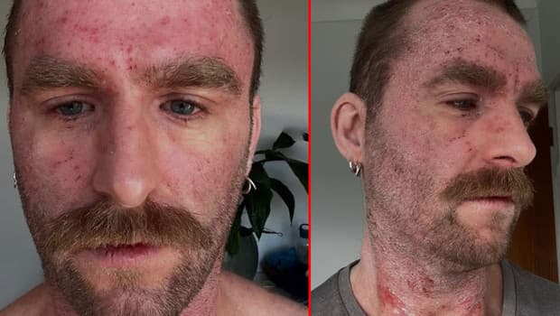 30 Yıl Süren Acıların Ardından İyileşmeyi Başardı: İlaçsız Çözüm Buldu