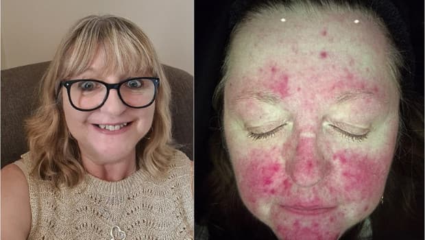 From Struggle to Clarity: How Jane Smith Overcame Rosacea Without Medication