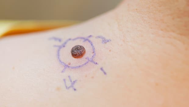 Worrying Trends: Cancer Deaths Projected to Rise by 2050