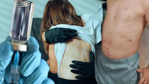 Turkey Introduces Second Dose of Chickenpox Vaccine for Young Children